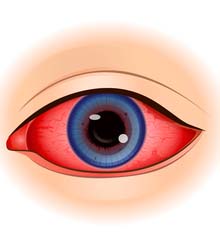 Inflammation of the cornea due to any eye disease